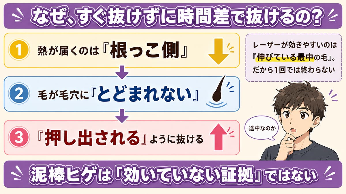レーザーの熱が毛の根っこ側に届くため、泥棒ヒゲが時間差で抜ける流れをまとめた見出し画像