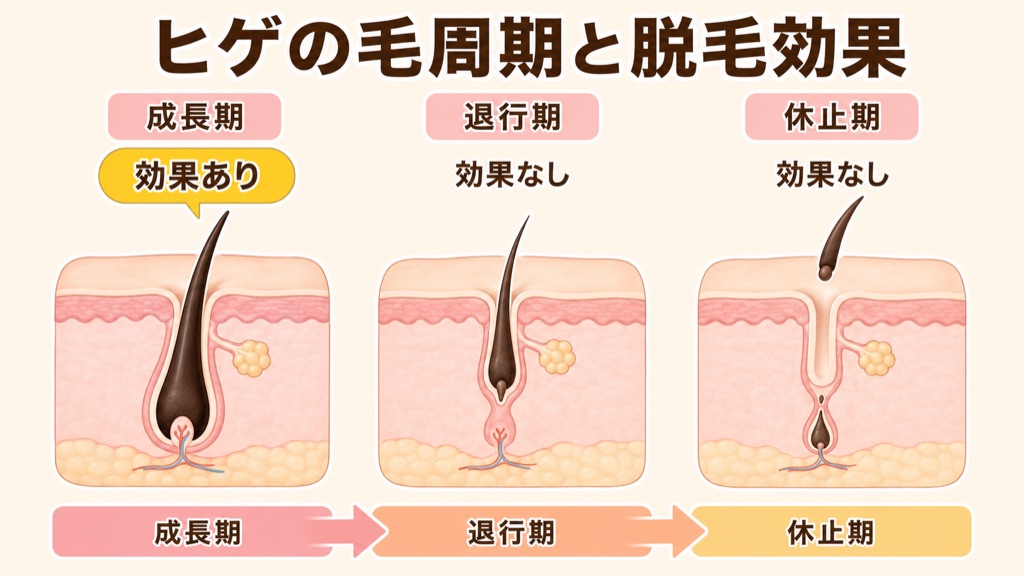 ヒゲの毛周期を成長期・退行期・休止期の3つに分けた皮膚断面図。脱毛の効果が出るのは毛が深く根を張る成長期だけで、退行期と休止期は効果が出ないことを示している。