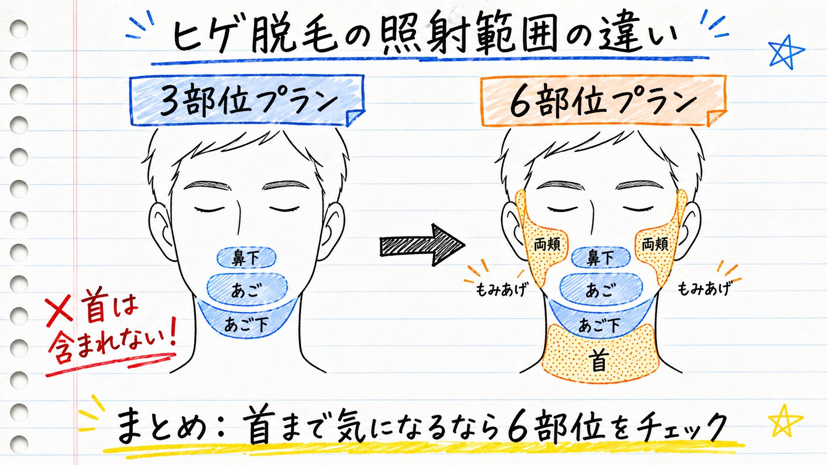 ヒゲ脱毛の照射範囲の違いを比較したノート風の図解。3部位プラン（鼻下・あご・あご下）と6部位プラン（両頬・もみあげ・首を含む）の照射範囲を顔のイラストで示している
